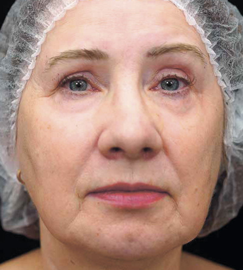 Bioregen + CO₂-лазер