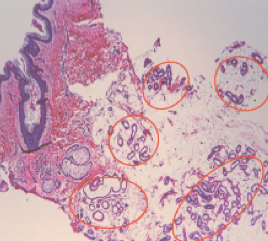 лечение гипергидроза на аппарате MiraDry