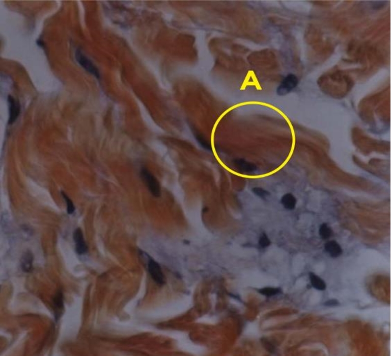 Sculptra деградация частиц PLLA в тканях