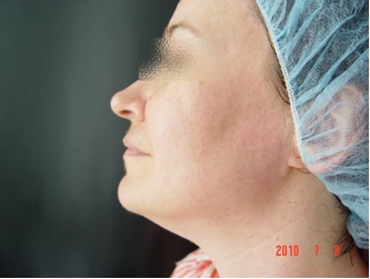 Пациентка с избытками кожи и подкожно-жировой клетчатки в субментальной области и области шеи. Пациентка с избытками кожи и подкожно-жировой клетчатки в субментальной области и области шеи.