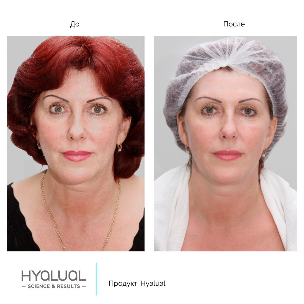 Hyalual 2,2 %, фото до и после