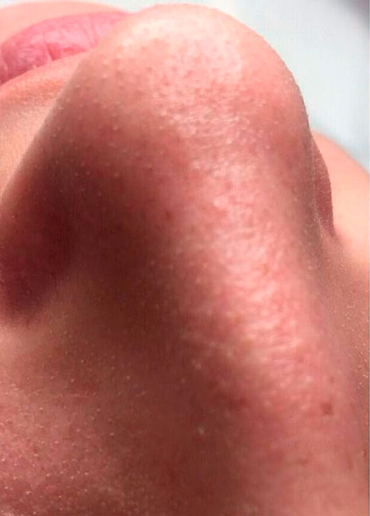 препараты Magiray для коррекции акне