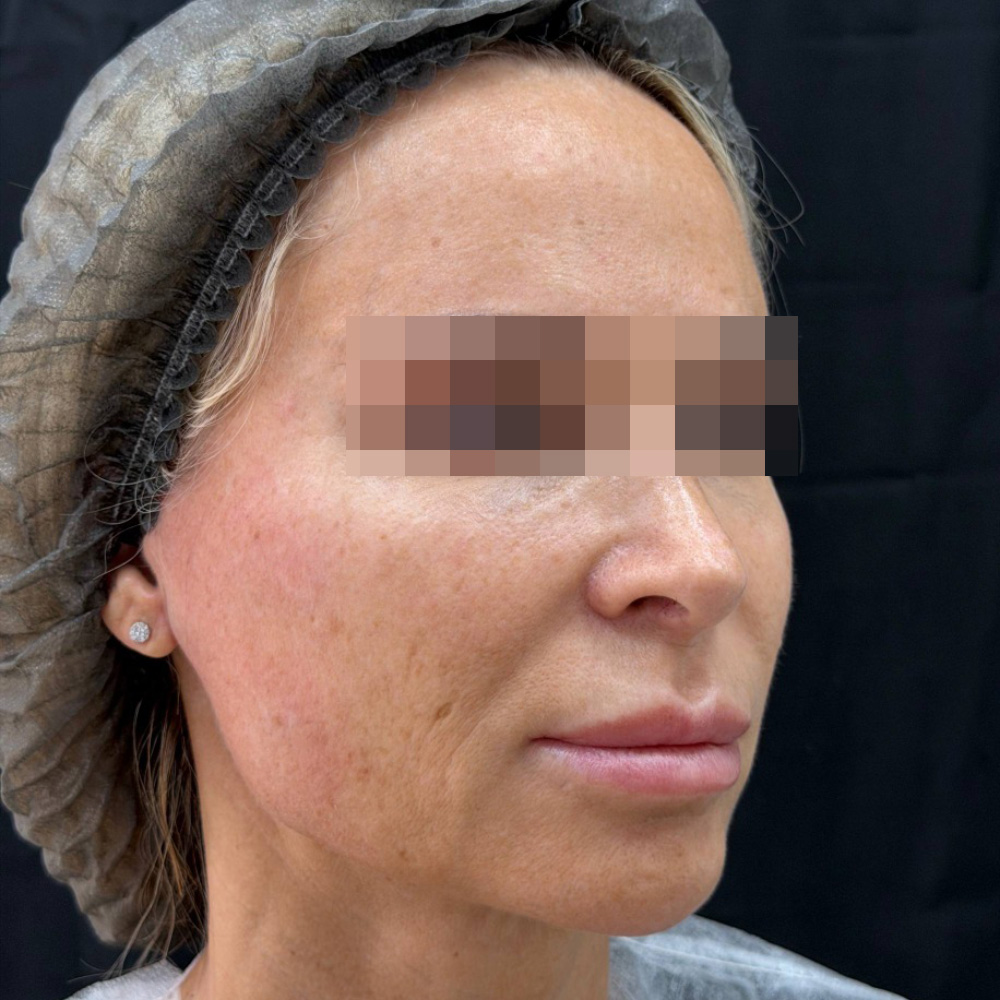 Oligio и Neauvia: фото после