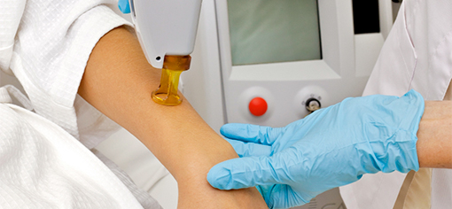 Лазерная эпиляция