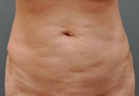 Ultherapy живот, фото до