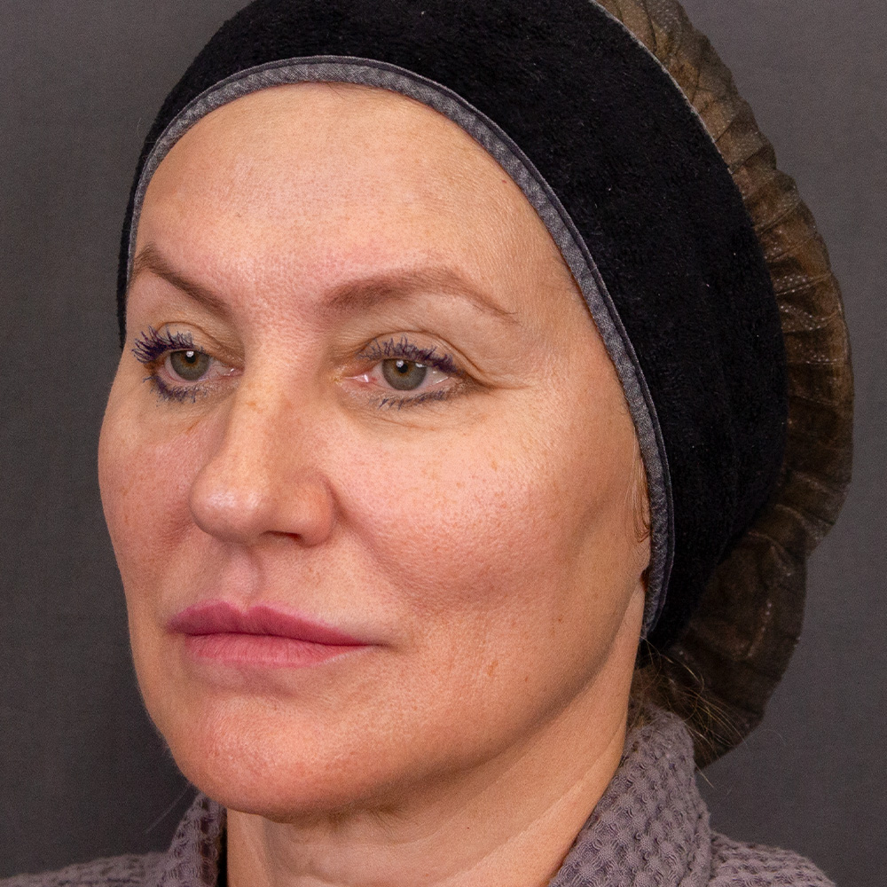 Протокол процедуры Peach Peel PRO и Colibriderm Hydro, фото до