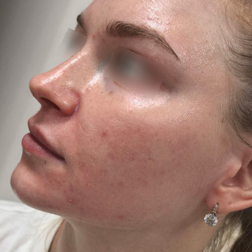 Ixtron Sprint Angel, фото после 1 процедуры