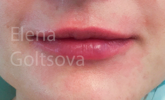 коррекции сложных тонких губ препаратом Belotero Intense, фото после процедуры