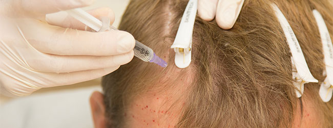 Лечение выпадения волос