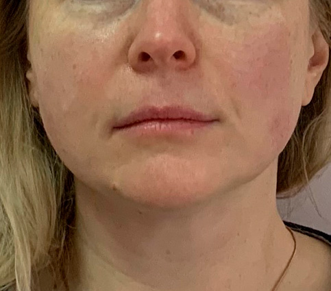 Асимметрия лица – асимметрия SMAS