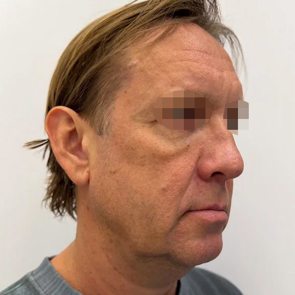 Neauvia Man, фото до и после