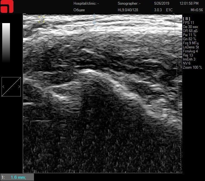 Тонкая кожа – поверхностное расположение соединительной ткани подкожно-жировой клетчатки и SMAS-слоя