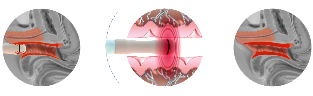 аппарат Exilis Ultra 360™ BTL Industries