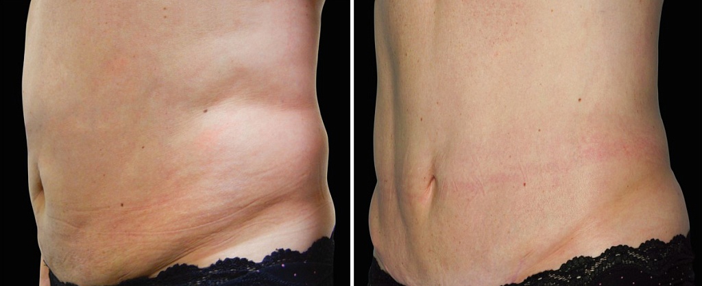 Фото жировые отложения до и после Акваликс