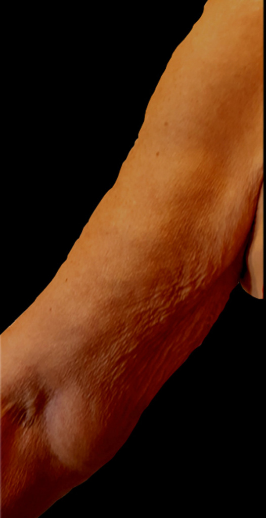 Скульптра (Sculptra) фото до