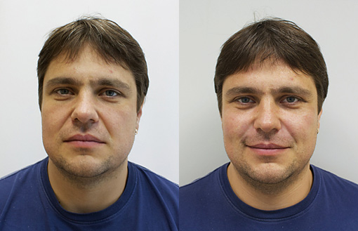 подтяжка лица +до +и после