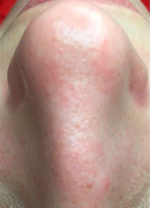 препараты Magiray для коррекции акне