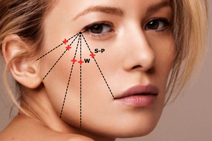 скуловая область, разметка, Restylane Perlane