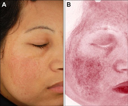 Сосудистые изменения при мелазме