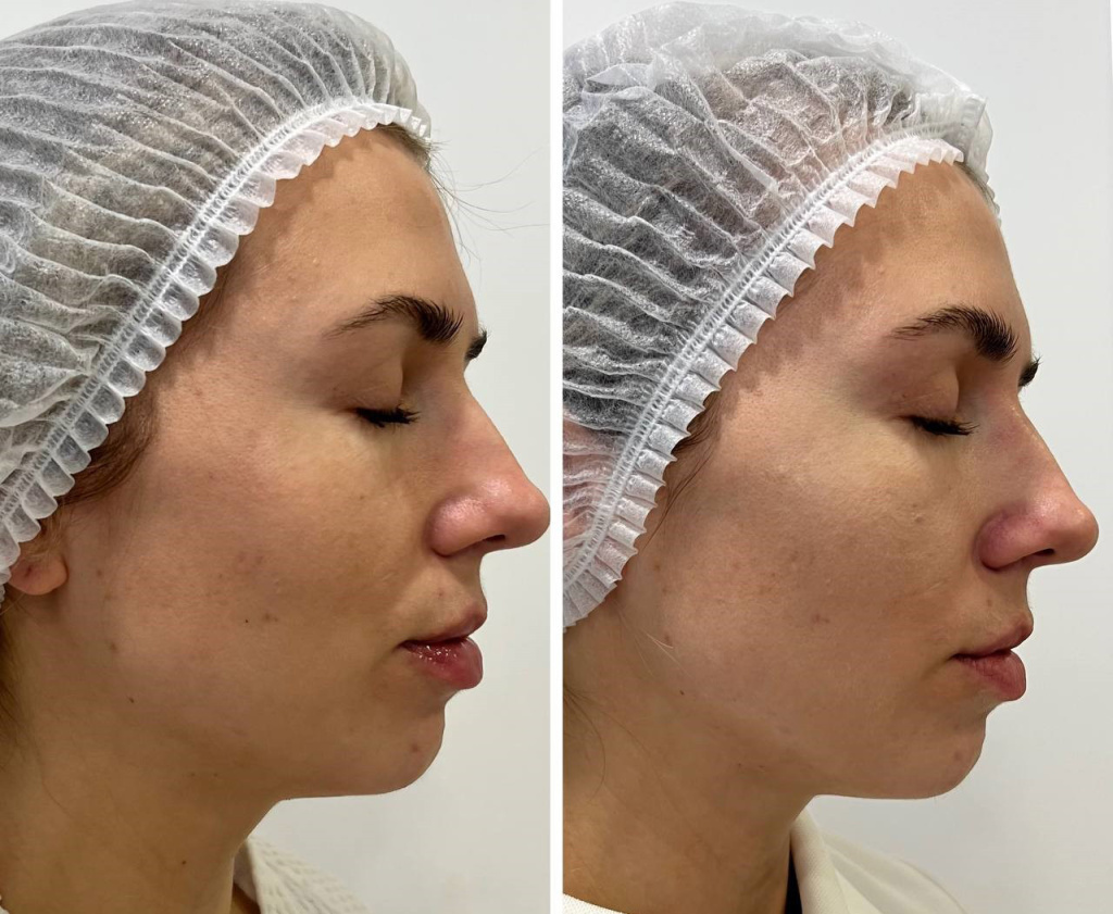 Calecim Professional Serum