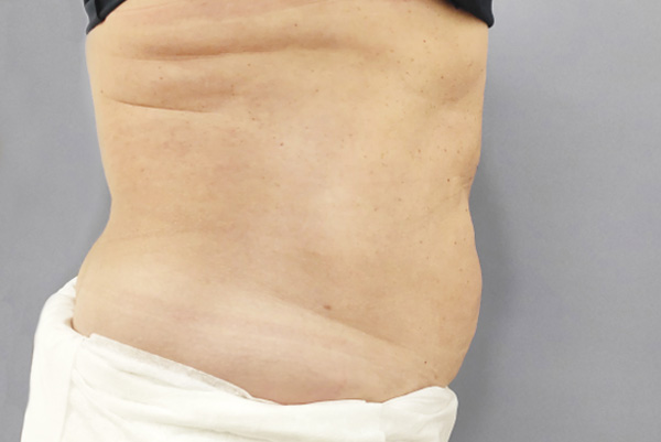 SLIMUS, фото до и после