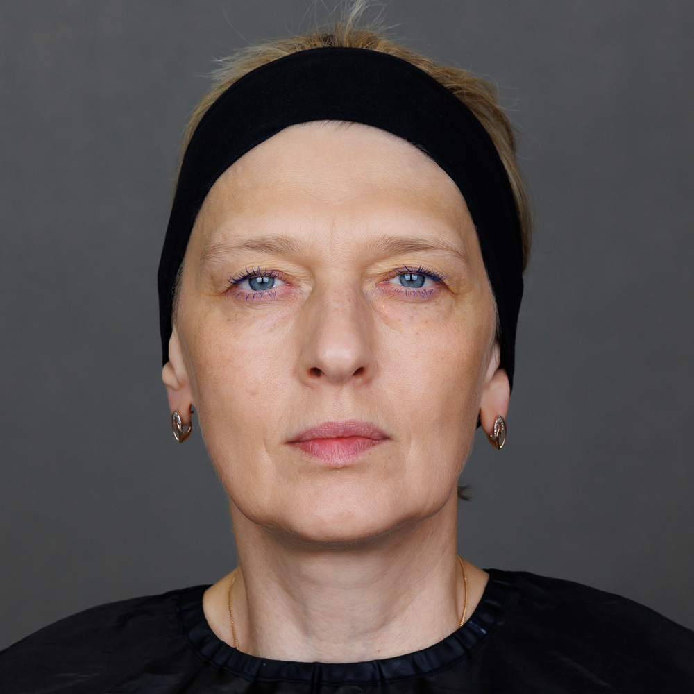 Микроигольчатая RF-терапия Morpheus 8 (InMode): фото после