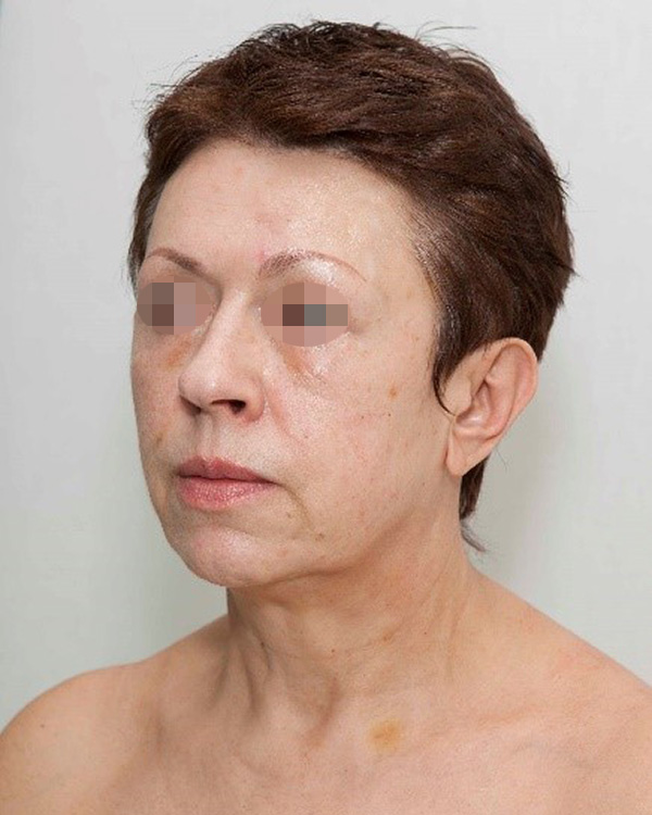 Аминокислотно-заместительная терапия препаратом Jalupro®