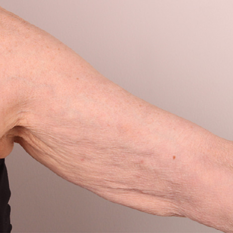 Ultherapy плечи, фото до