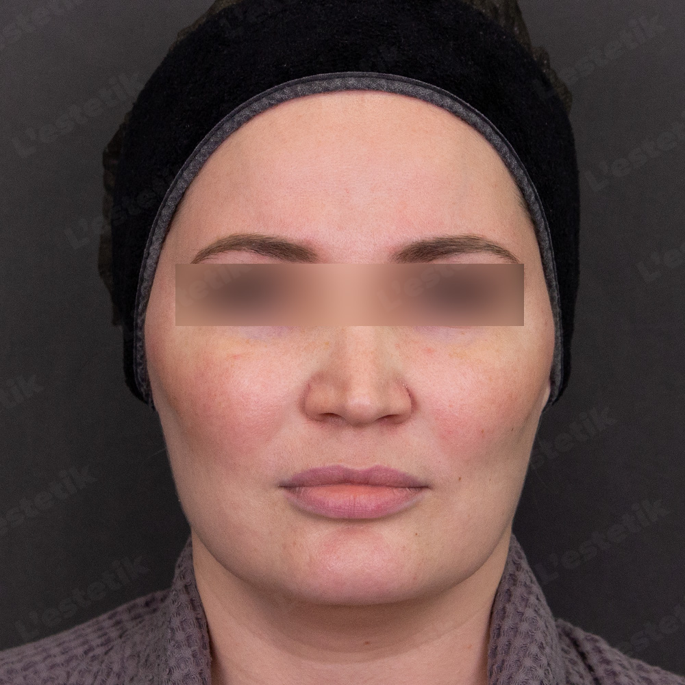 Клинический случай: розацеа