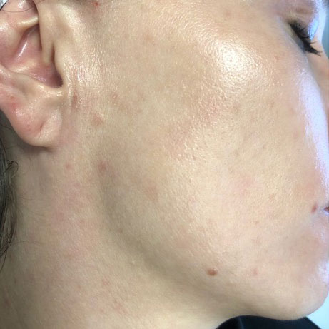 BBL BroadBand Light Acne