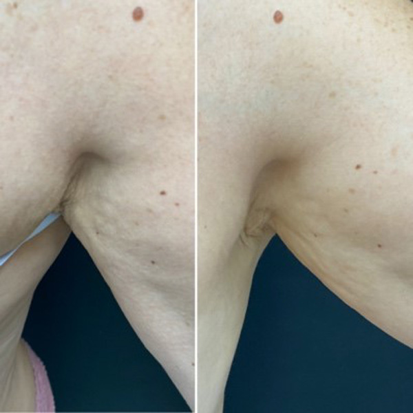 технология HIFU и инъекция Скульптра