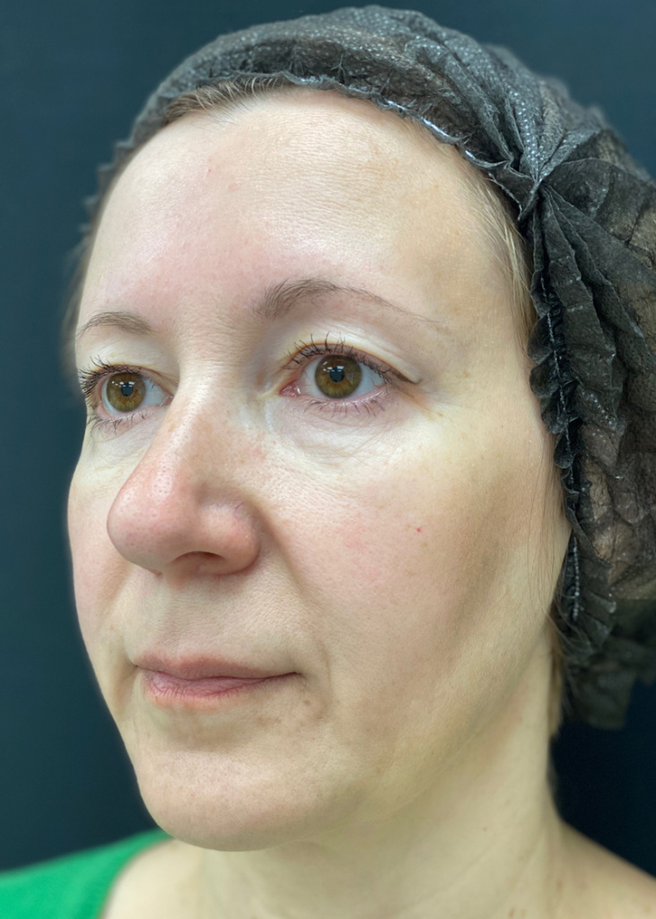 После проведения процедуры с препаратом MIRACOLL fille