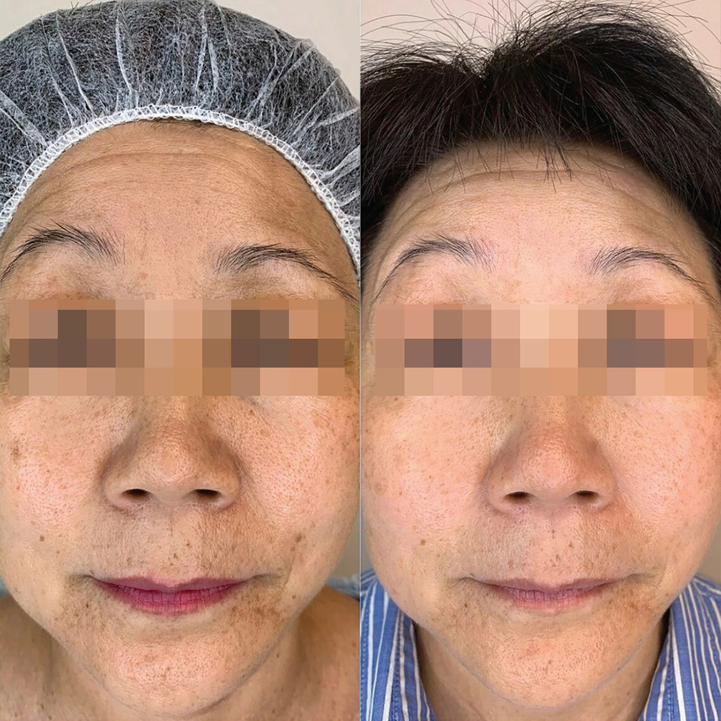 Результаты коррекции с помощью препаратов REVI