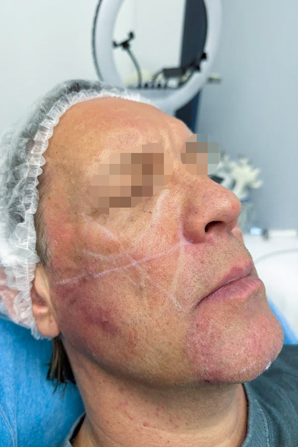 Разметка Neauvia