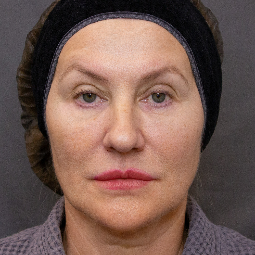 Протокол процедуры Peach Peel PRO и Colibriderm Hydro, фото после