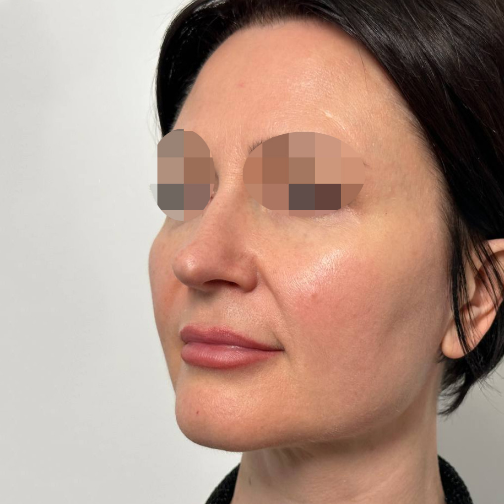 Express-Glow процедура