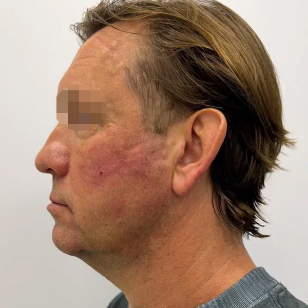 Neauvia Man, фото до и после