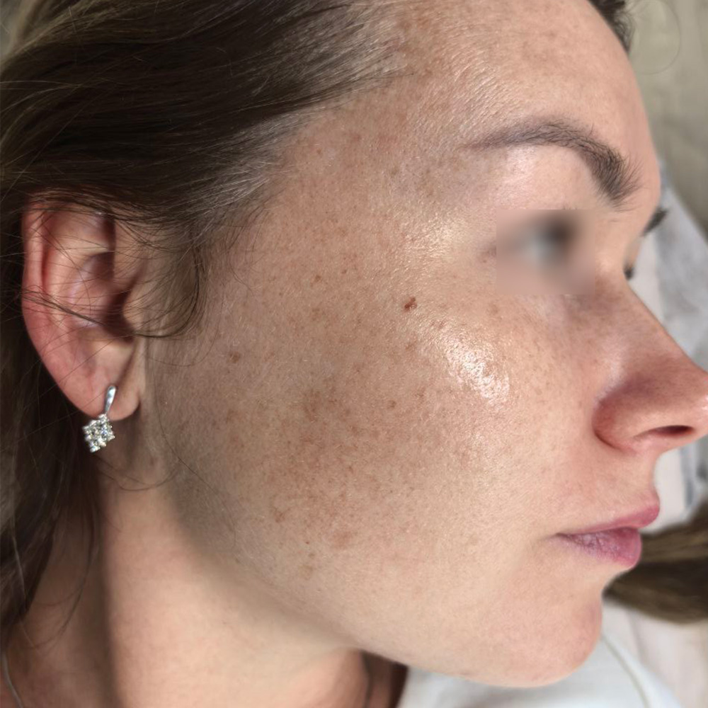 Ixtron Sprint Angel, фото до