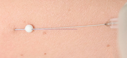 Подтяжка нитями