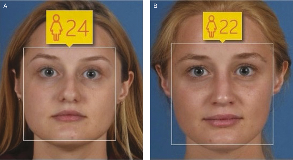 Результаты до и после ринопластики