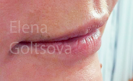 создание объема губ препаратом Belotero Balance, фото до процедуры