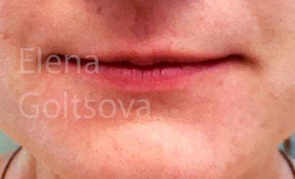 коррекции сложных тонких губ препаратом Belotero Intense, фото до процедуры