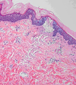 фракционный фототермолиз