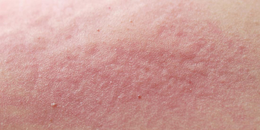 Чувствительная кожа симптомы