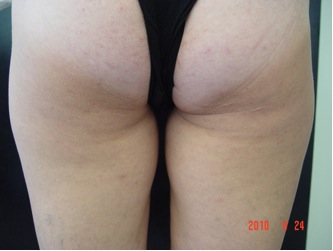 Лифтинг кожи и уменьшение проявлений целлюлита через 2 месяца после начала курса (проведено 4 процедуры). Лифтинг кожи и уменьшение проявлений целлюлита через 2 месяца после начала курса (проведено 4 процедуры).