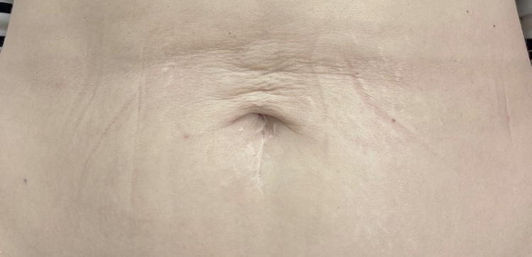 Скульптра плюс Thermage