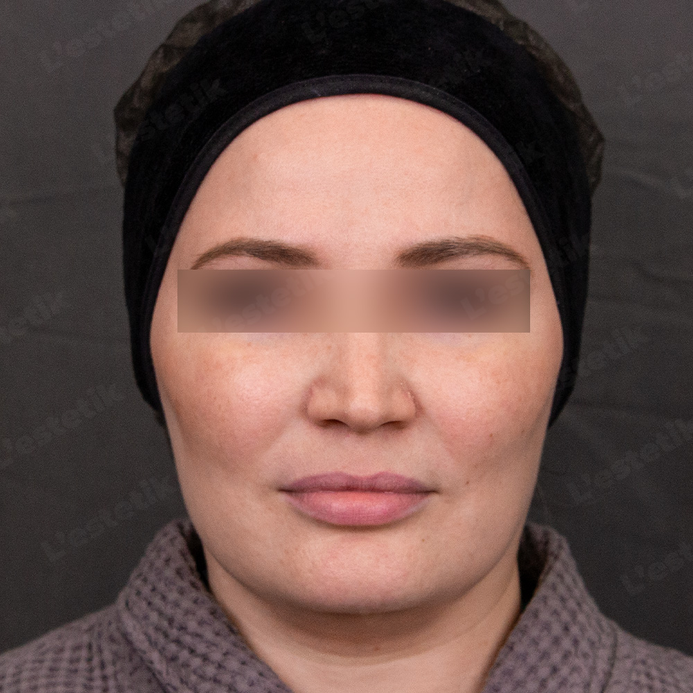 Клинический случай: розацеа