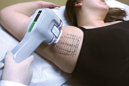 лечение гипергидроза на аппарате MiraDry