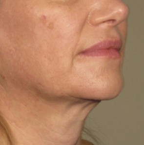 Фото после процедуры Ultherapy posle_Ulthera