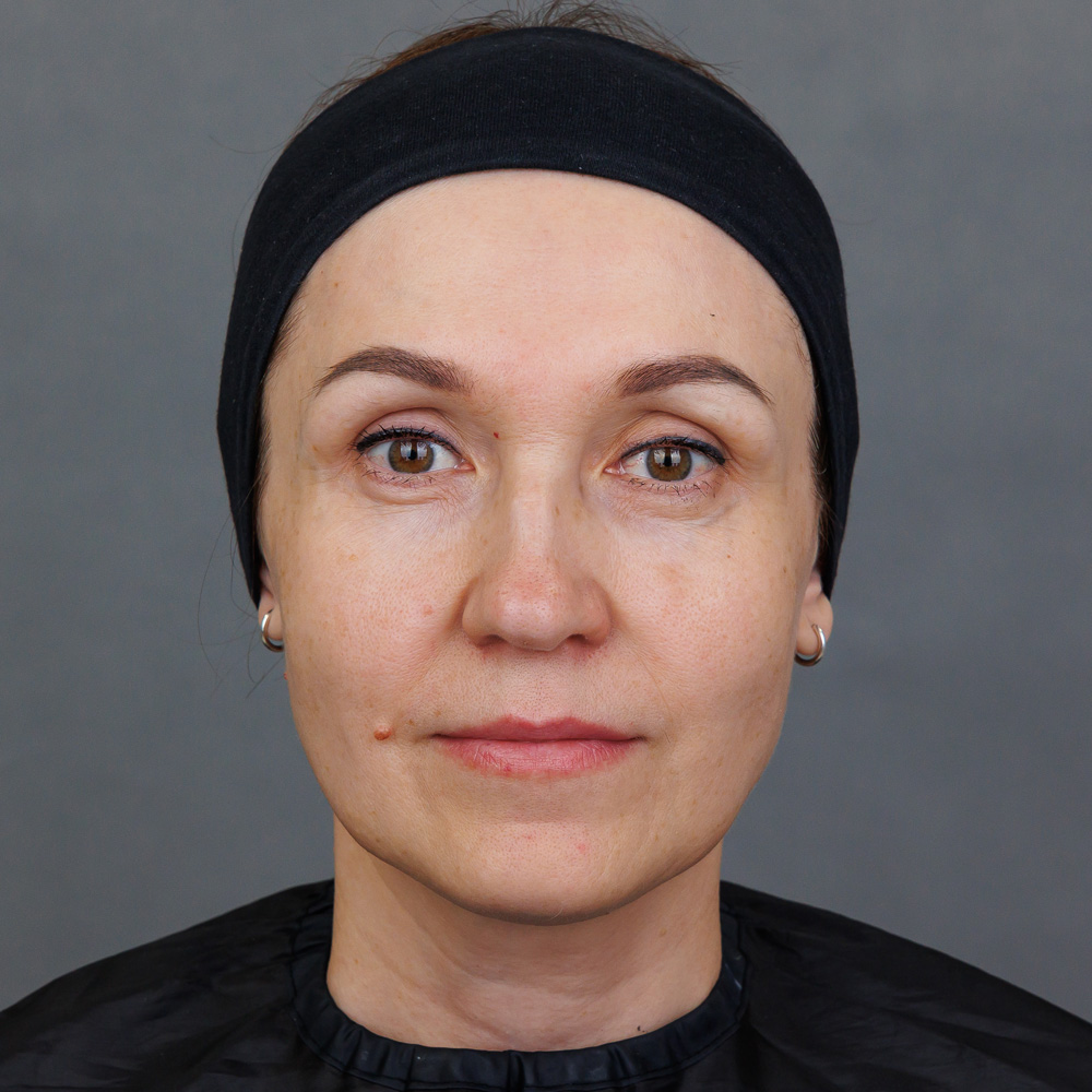 Микроигольчатая RF-терапия Morpheus 8 (InMode): фото до